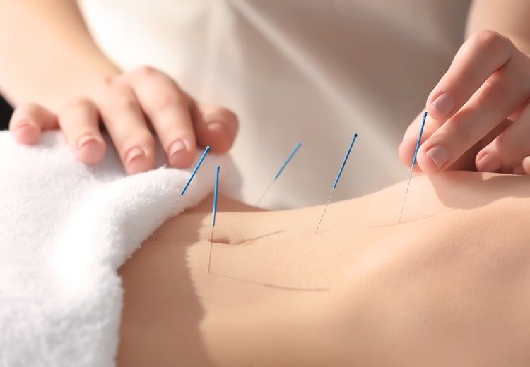 Acupuncture : soulager l'endométriose par la médecine douce - Heyme