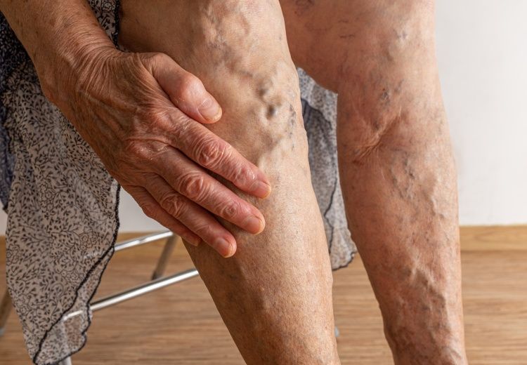 Ulcère de jambe : comment l’identifier et le soigner - Heyme